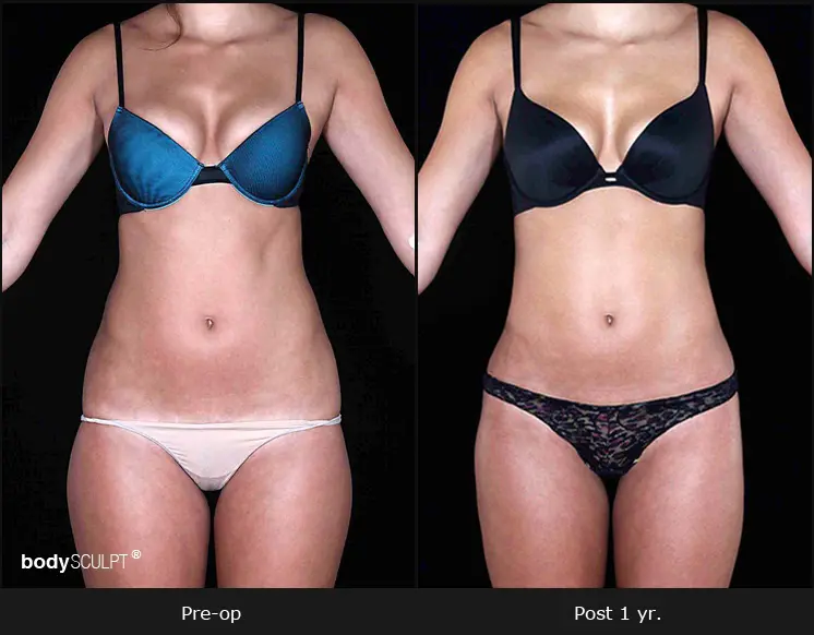 Smartlipo Flanks Liposuction for Women - Before & After Photos